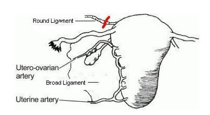 Round Ligament