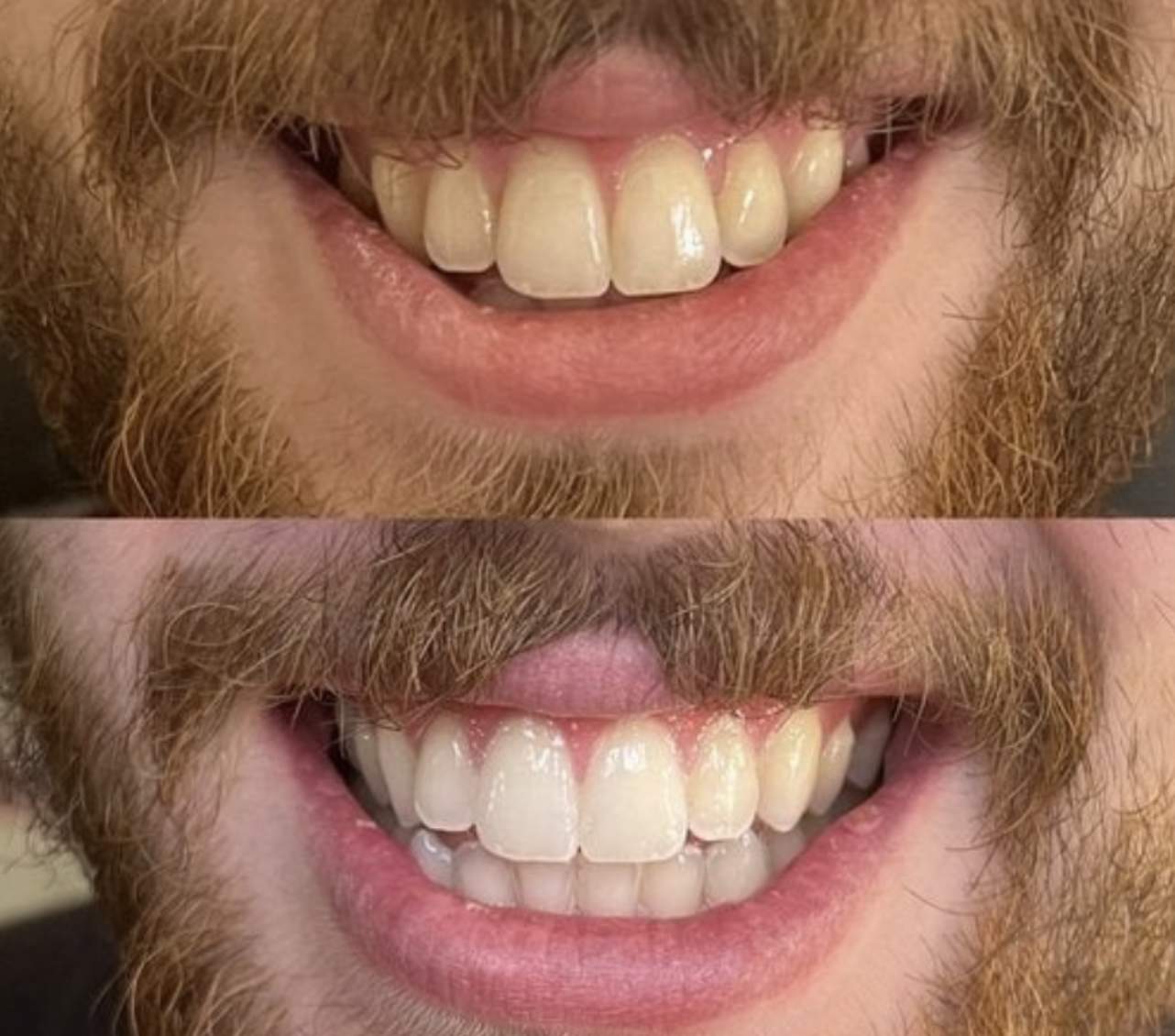 Teeth Whitening Vancouver WA