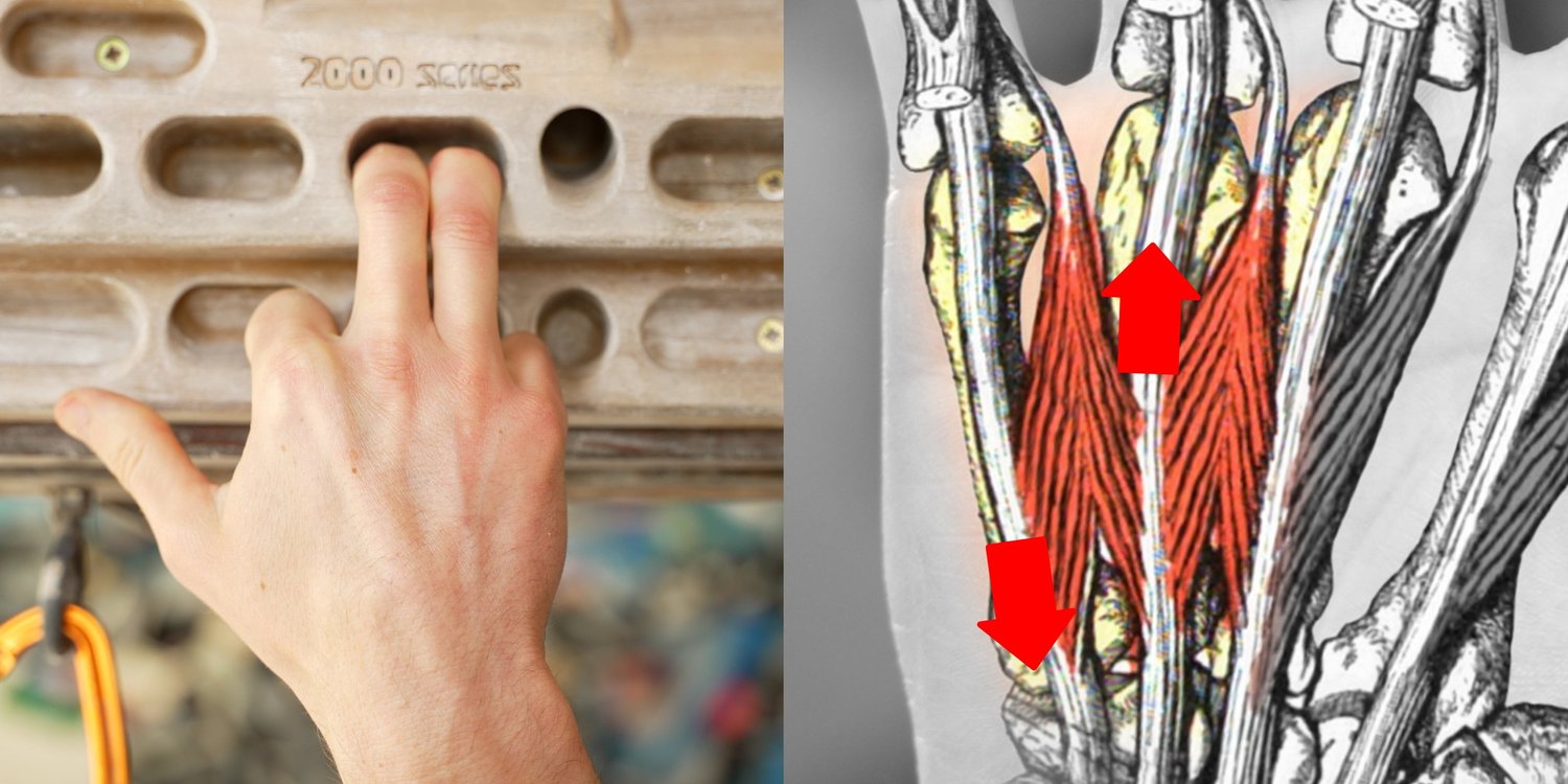 How to Fix Lumbrical Shift Syndrome from Rock Climbing (2025) — Hooper ...
