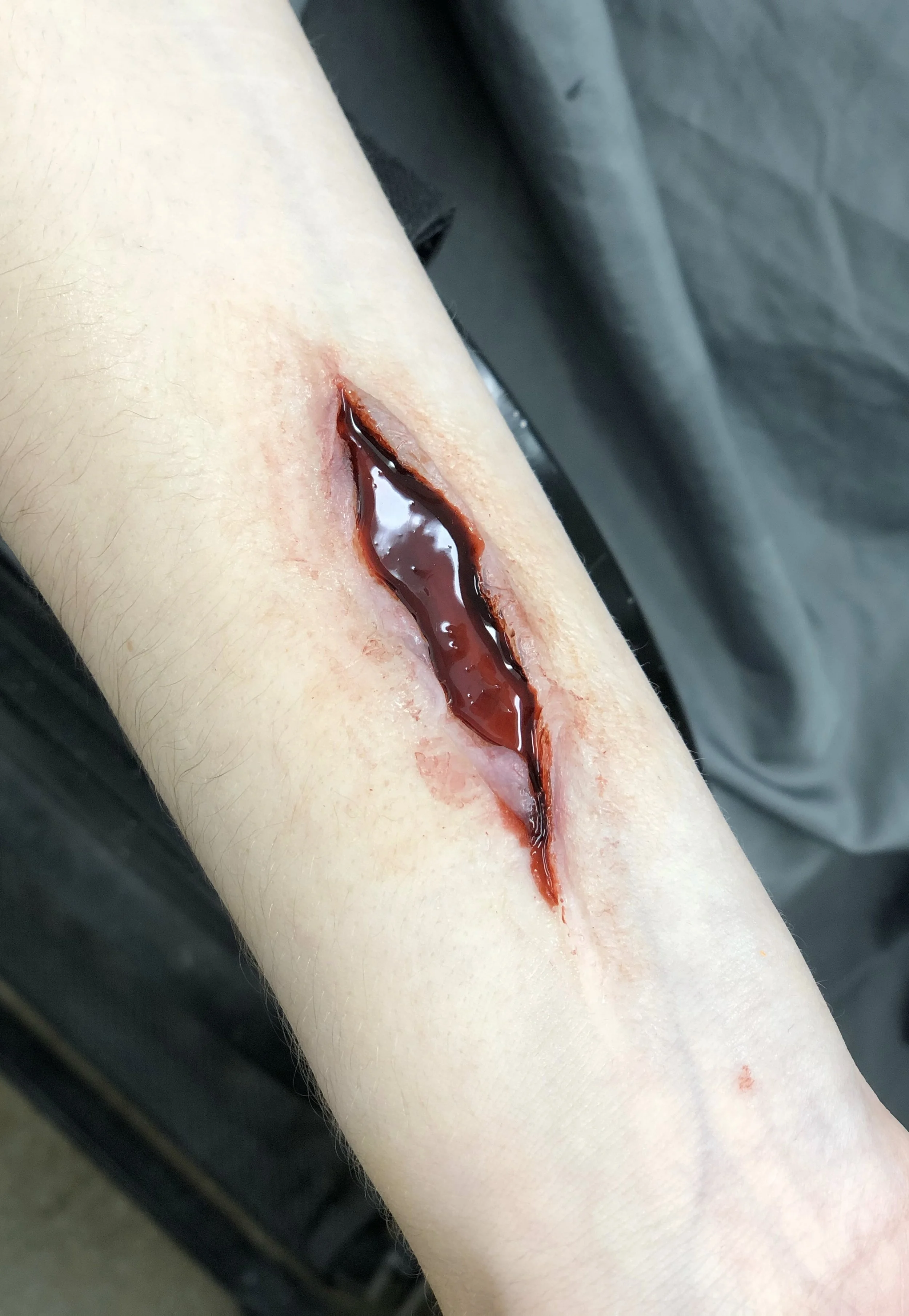  deep laceration 