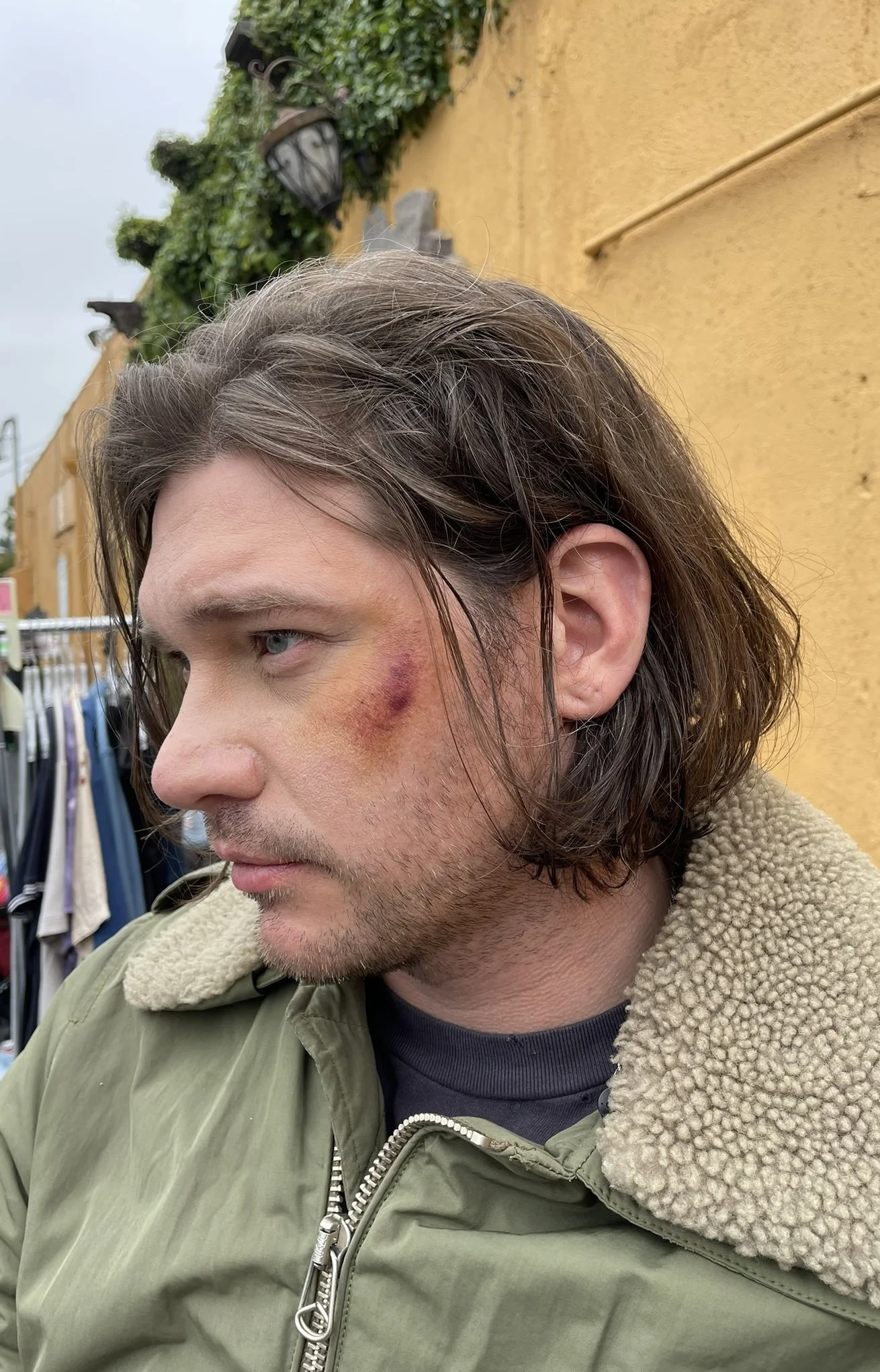  old bruise 