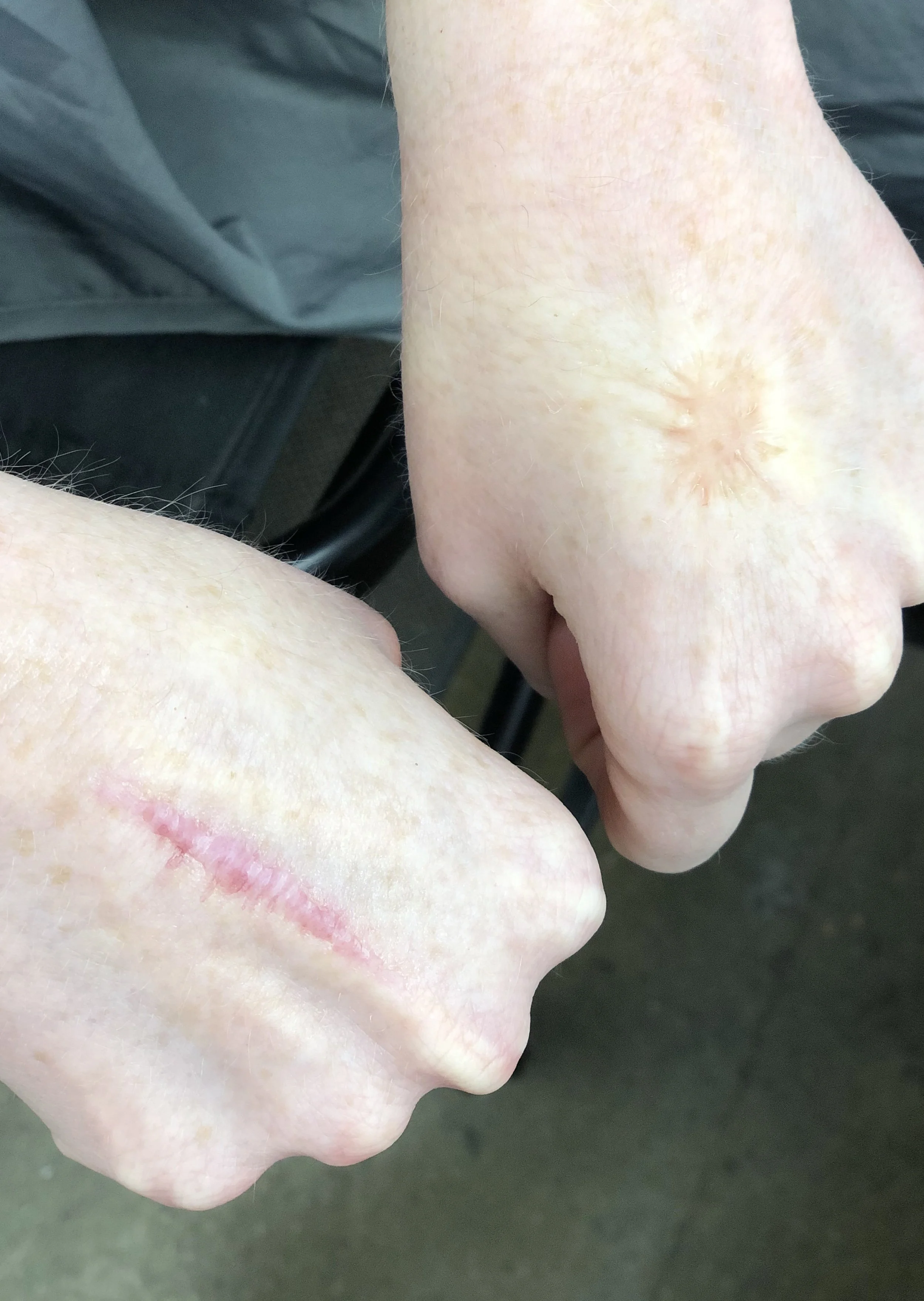  scarring and keloid 