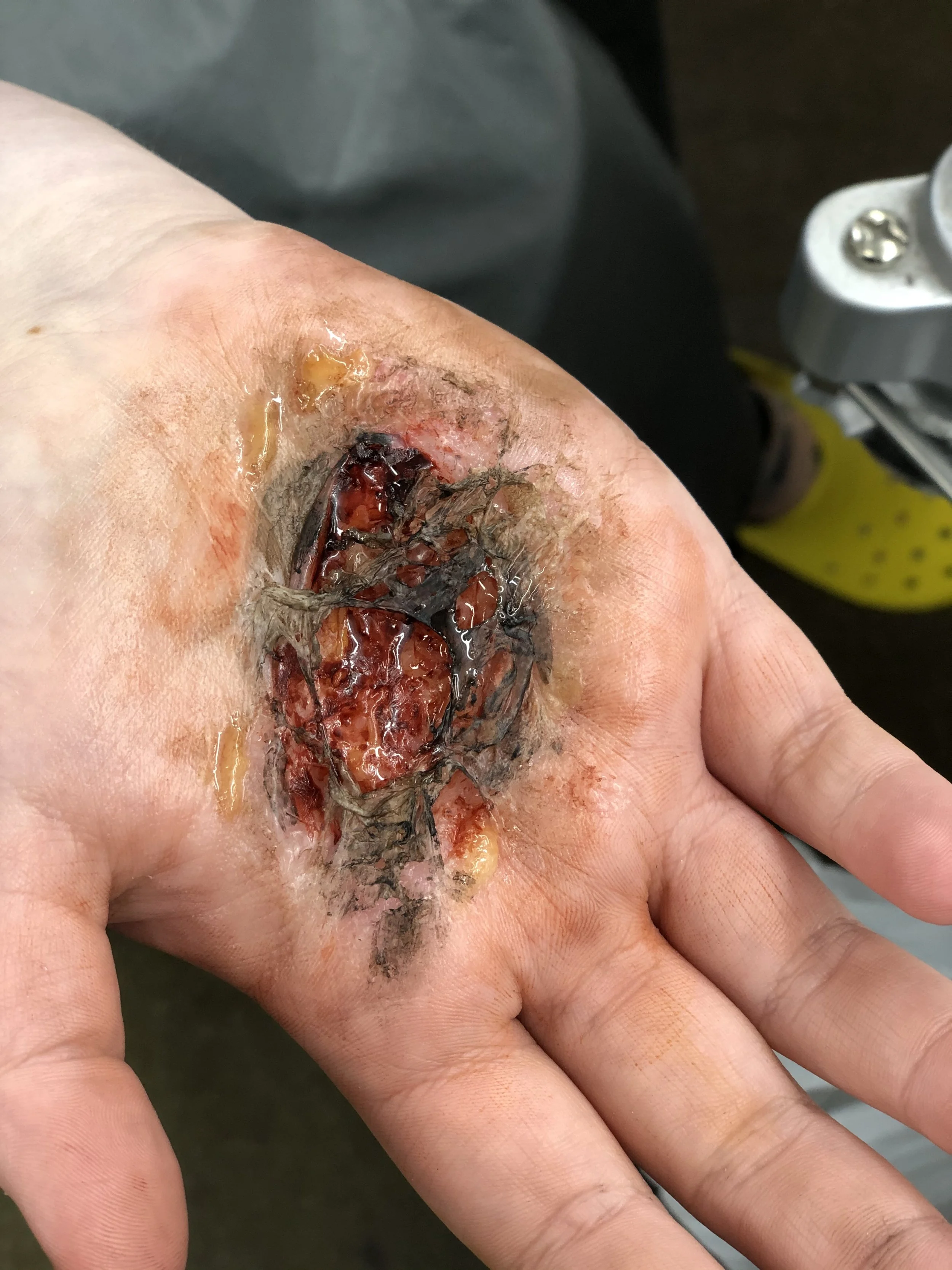  3rd degree silicone burn 
