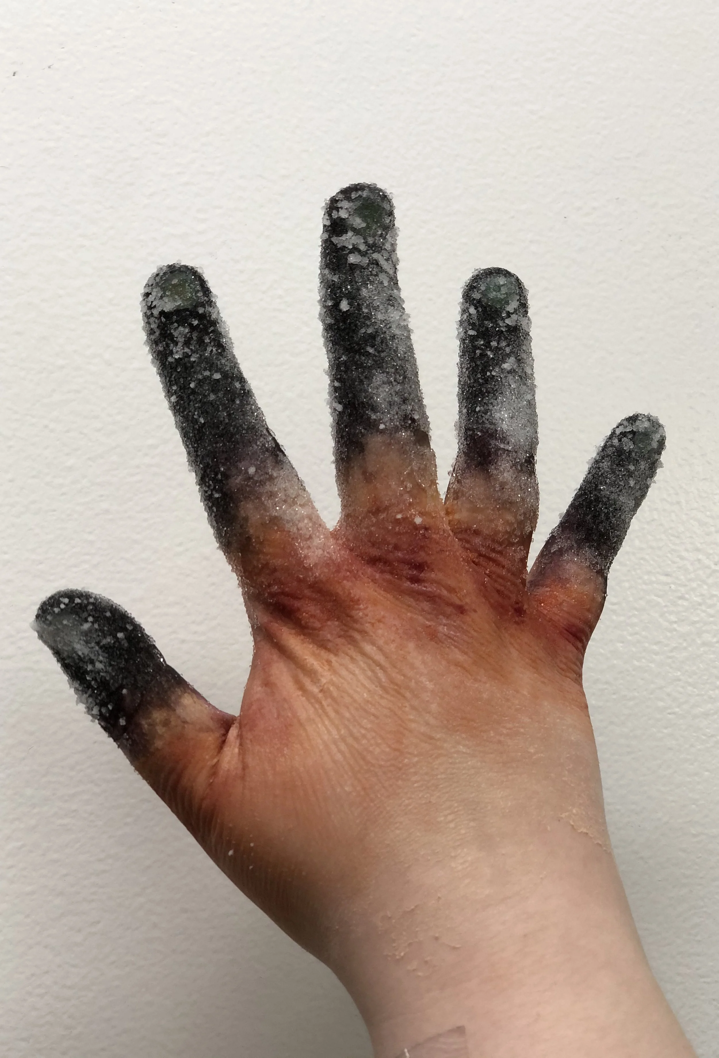  frostbite 
