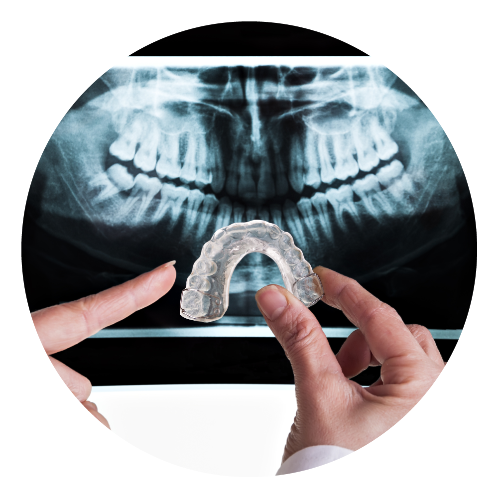 Bite Splint For Teeth Grinding — Dalby Family Dental