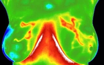ThermalBreast.jpg