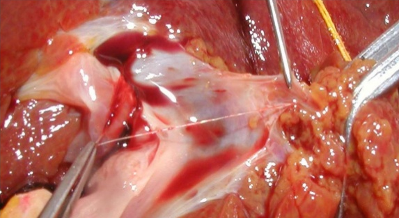 Bonghan duct inside blood vessel (Lee, et al., 2004)