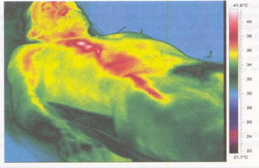 Moxibustion of stomach meridian (Schlebusch, et al., 2005)