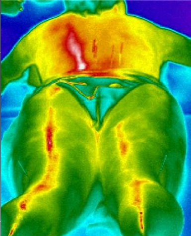 Moxibustion of gall bladder meridian (Schlebusch, et al., 2005)