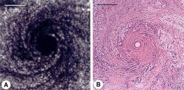Subcutaneous tissue of acupuncture point: A) ultrasound scanning acoustic microscopy; B) fixed, embedded, sectioned and stained (Langevin, 2002)