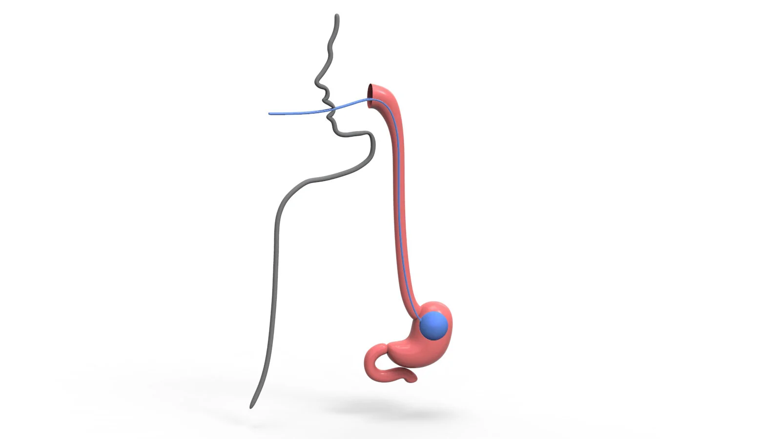 Our Options — Gastric Sleeve, Gastric Bypass, Bariatric Surgery