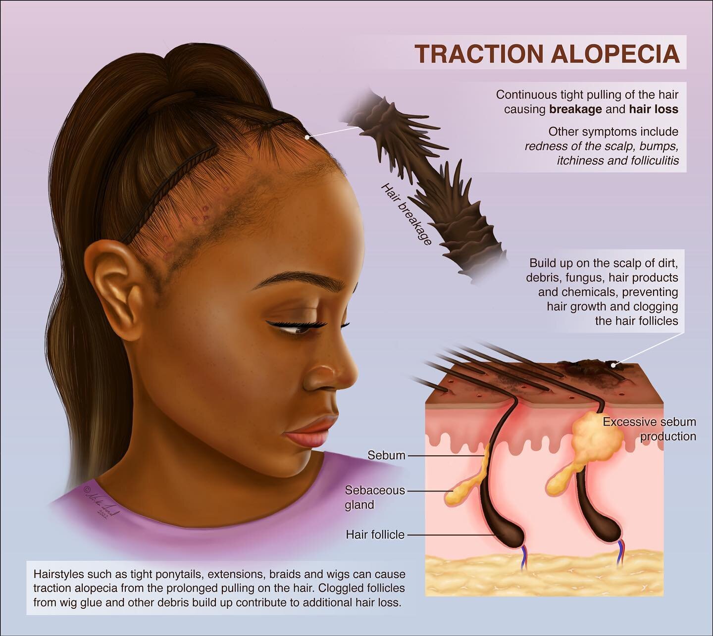 An illustration I did last year on traction alopecia and hair problems that can affect Black women. Hairstyles like tight ponytails, sew-in weaves, and tight wigs can lead to hair loss. Additionally hair follicles can become inflamed and clogged from