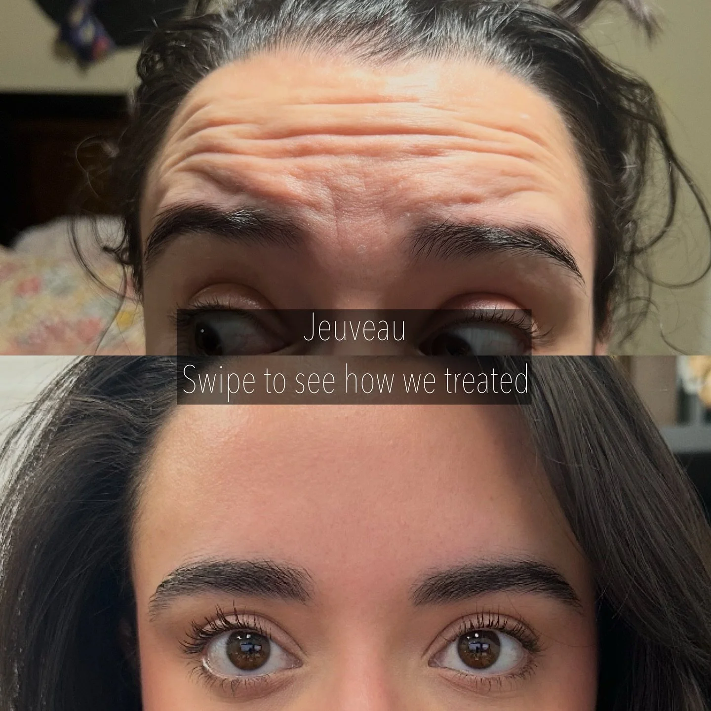 Neurotoxin in combination with targeted skincare can transform your skin completely. 
Follow along to see more examples of treated areas. 

#botox #rockwallbotox #dallasbotox #heathbotox #forneybotox #rowlettbotox #roysecitybotox #jeuveau #rockwallje