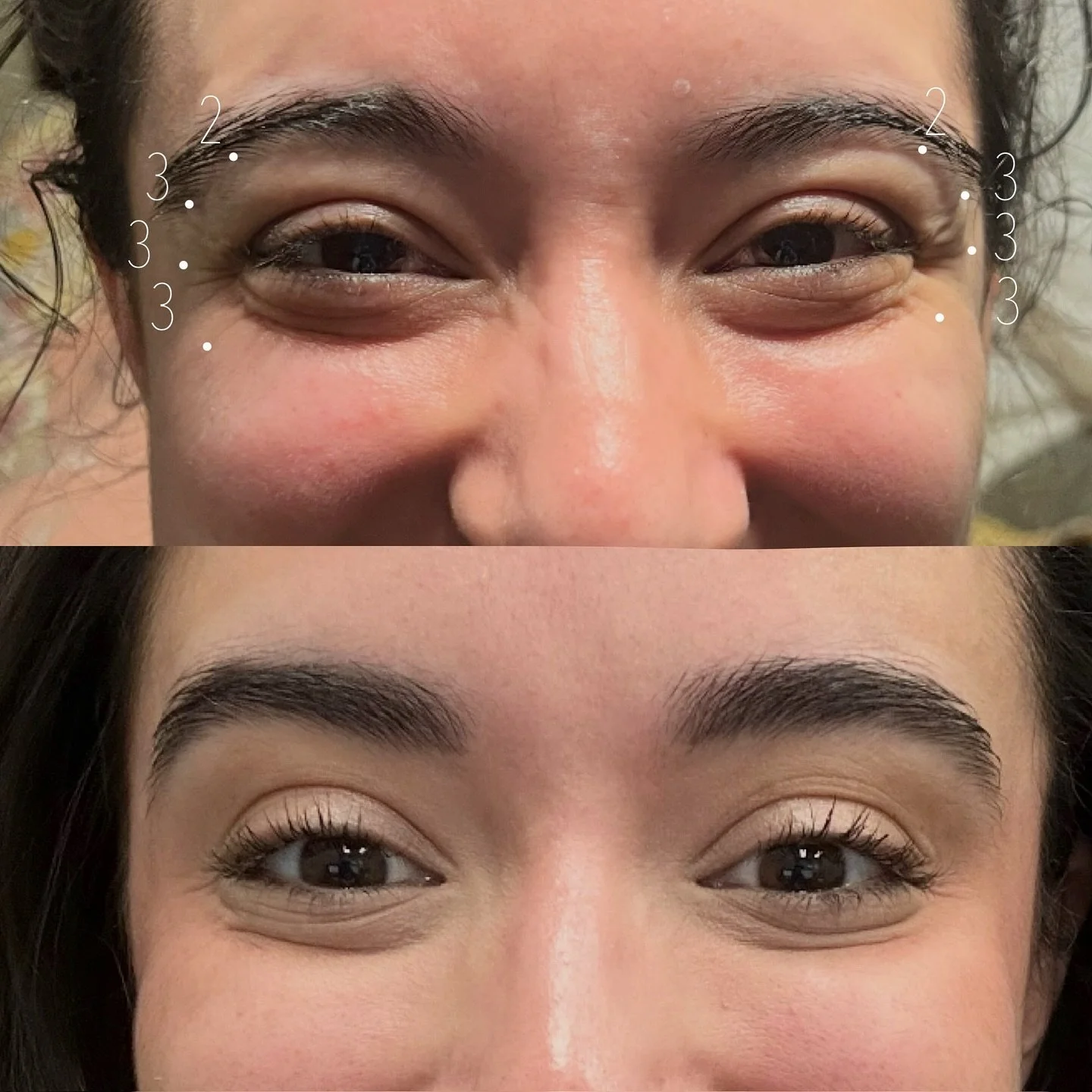 These results were achieved by strategically treating the orbicularis oculi muscle with neurotoxin. By relaxing this muscle, we can soften crow&rsquo;s feet, reduce that &ldquo;gathering&rdquo; under the eyes when smiling, and even create a gentle br