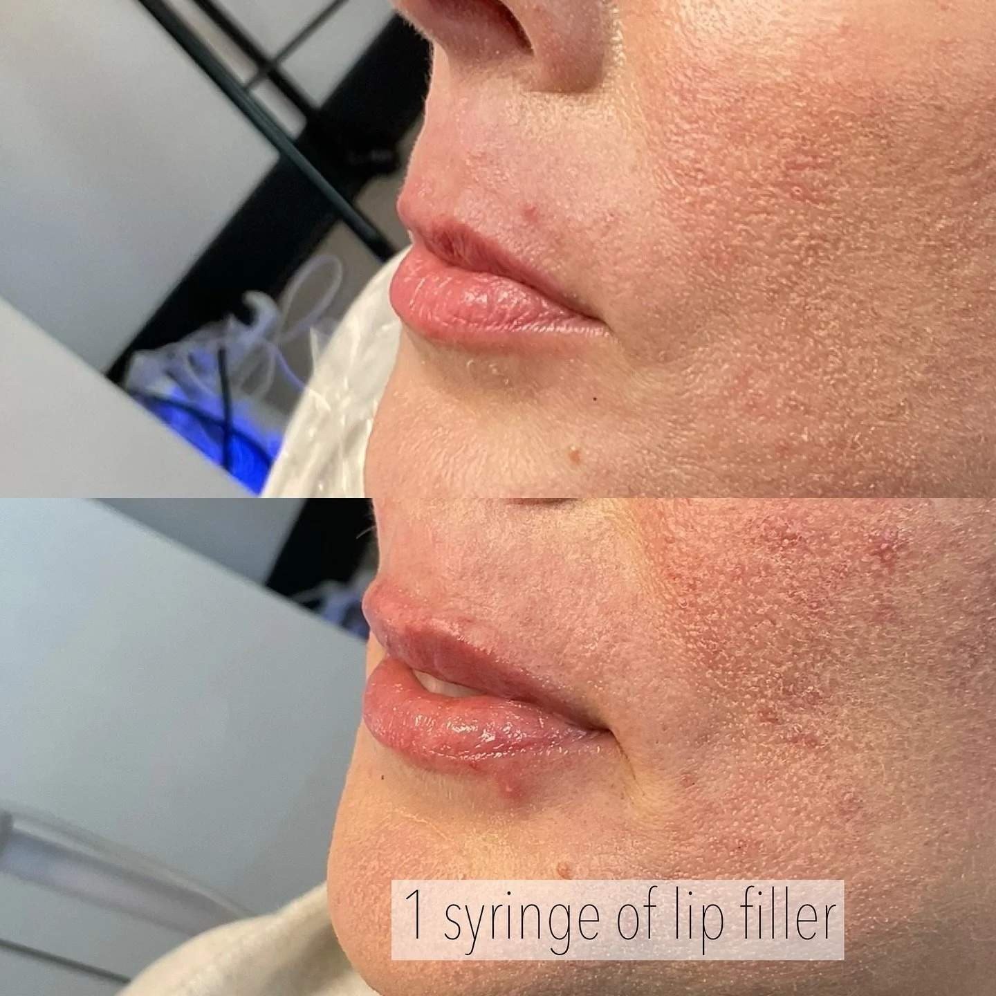 Subtle volume with 1 syringe of lip filler 💉

#lipfiller #rockwalllipfiller #dallaslipfiller #heathlipfiller #forneylipfiller #mesquitelipfill #planolipfiller #friscolipfiller