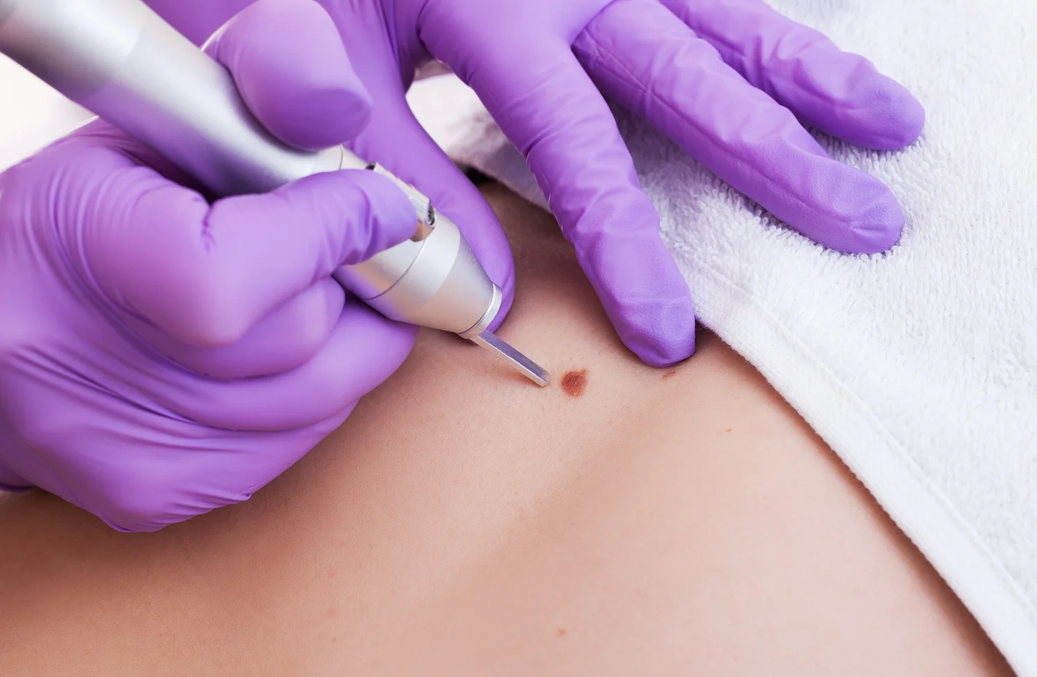 Mole removal – Vitalize Skin and Wellness Clinic, Kent — Vitalize