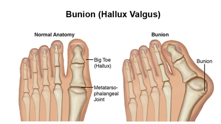 Physical Therapy for Bunions-Mangiarelli Rehabilitation