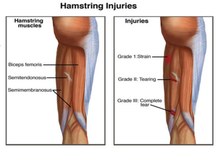 Physical Therapy Treatment For Hamstring Strain Injuries Mangiarelli 