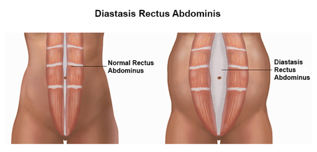 Physical Therapy for Postpartum Diastasis Recti-Mangiarelli