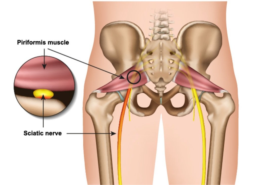 Piriformis Syndrome: Early Signs, Treatments, and Exercises - Physiotherapy  Toronto