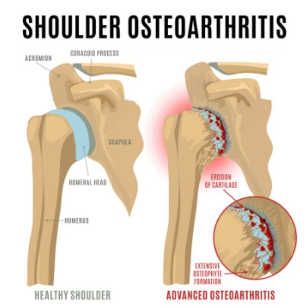 Physical Therapy in Baker County for Osteoarthritis Acromioclavicular