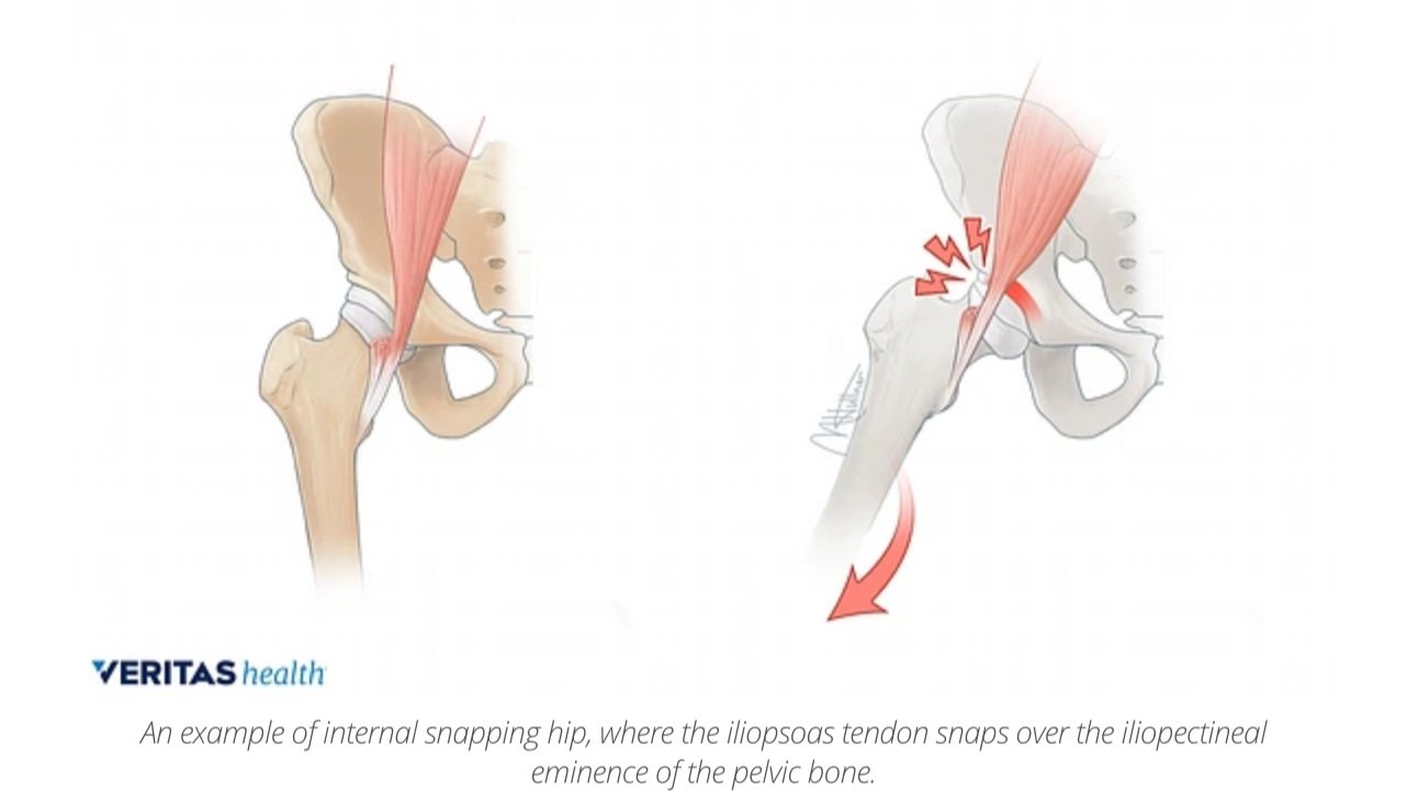 Physical Therapy for Snapping Hip Syndrome-Mangiarelli Rehabilitation