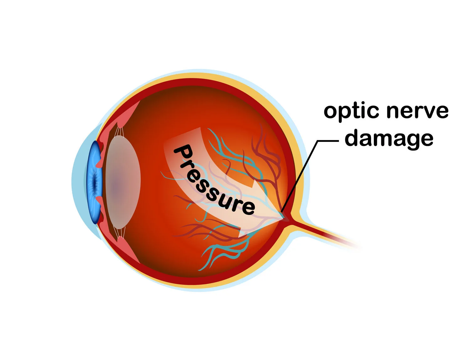 glaucoma-pressure-330x220@2x+(1)-01.jpg