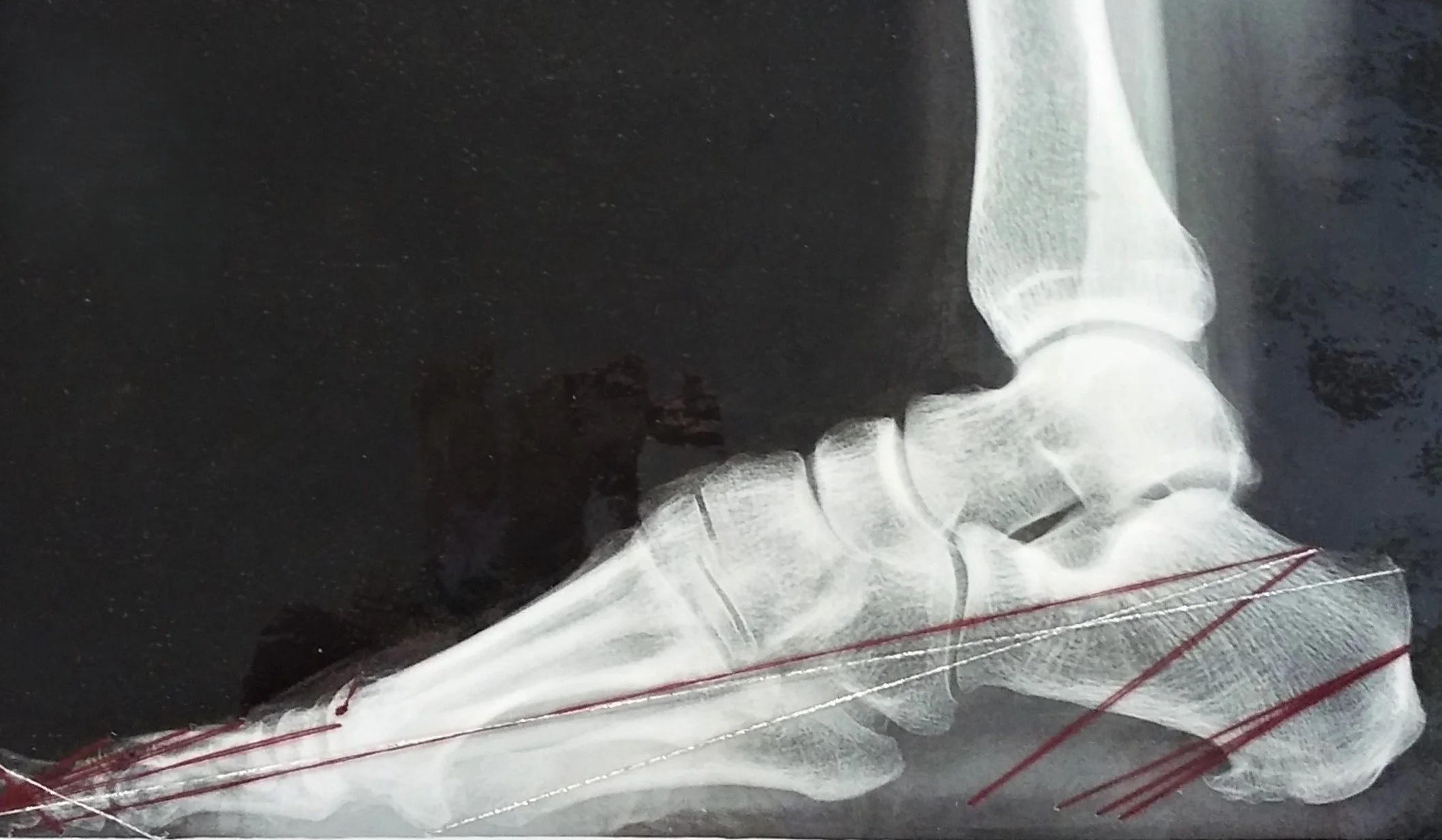 Webster_Sharon_My%20Stitched%20Right%20Foot%2C%20verticle_%202019_%20Lamenated%20xray%2C%20red%20thread%2C%20mounted%20on%20painted%20board._12%20INCHES%20X%2015%20INCHES%20framed_%24300.jpg
