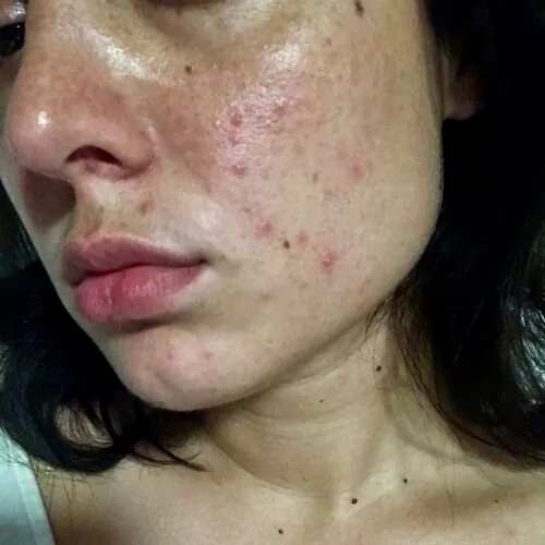 How to deal with the skin Purging Process! — self.skin