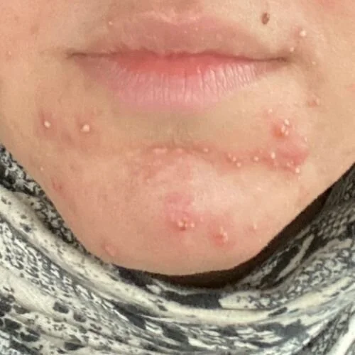 How to deal with the skin Purging Process! — self.skin