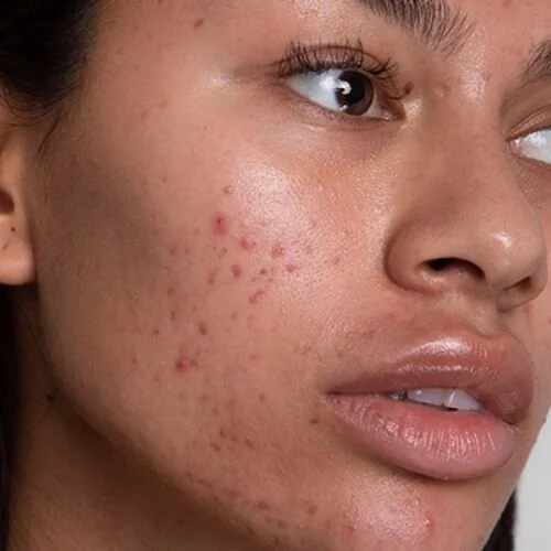 How to deal with the skin Purging Process! — self.skin