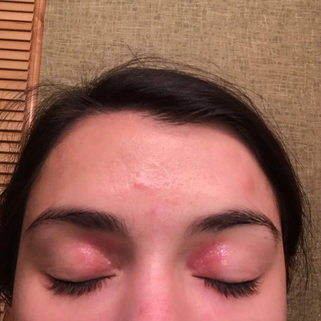 Eczema Eyelids