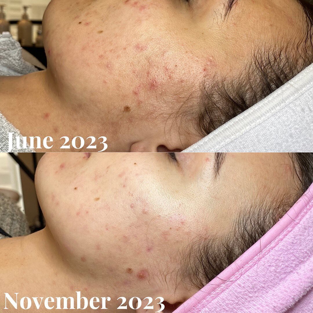 4 treatments later and we made amazing changes in:
🍉skin texture
🍉acne
🍉discolouration 
🍉scarring
🍉overall skin health

Skin is looking glowy and healthy! We can&rsquo;t wait to continue to see changes✨

#skinhealth #acnepositivity #acnescarring