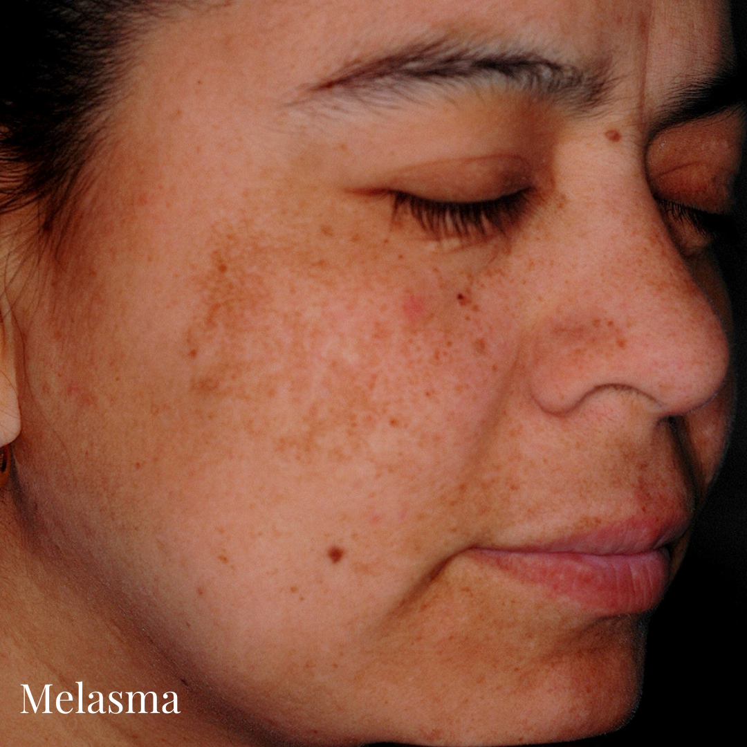 Common Skin Conditions During Pregnancy. — self.skin