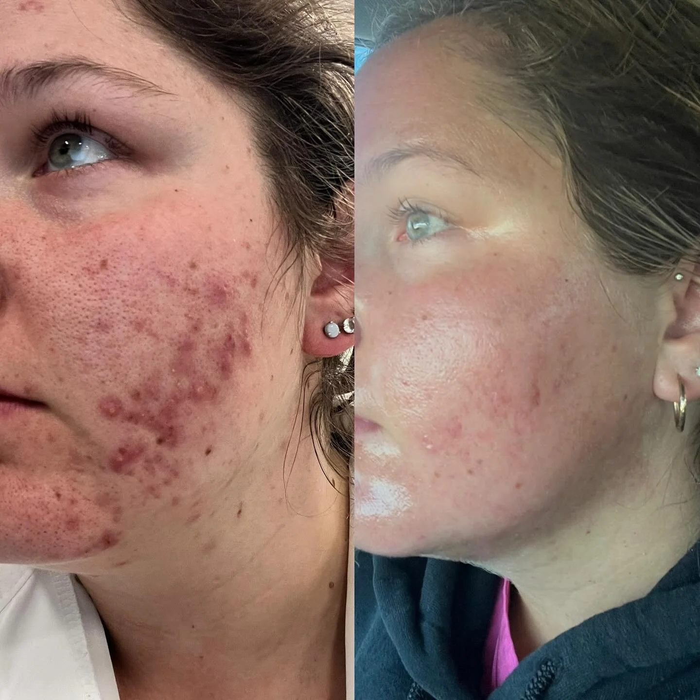Only 3 sessions of Fractional Resurfacing Laser treatments and Kristen is walking into her wedding day with smooth, glowing skin 🤍

This advanced treatment works by creating micro-channels in the skin, stimulating collagen + elastin production. The 