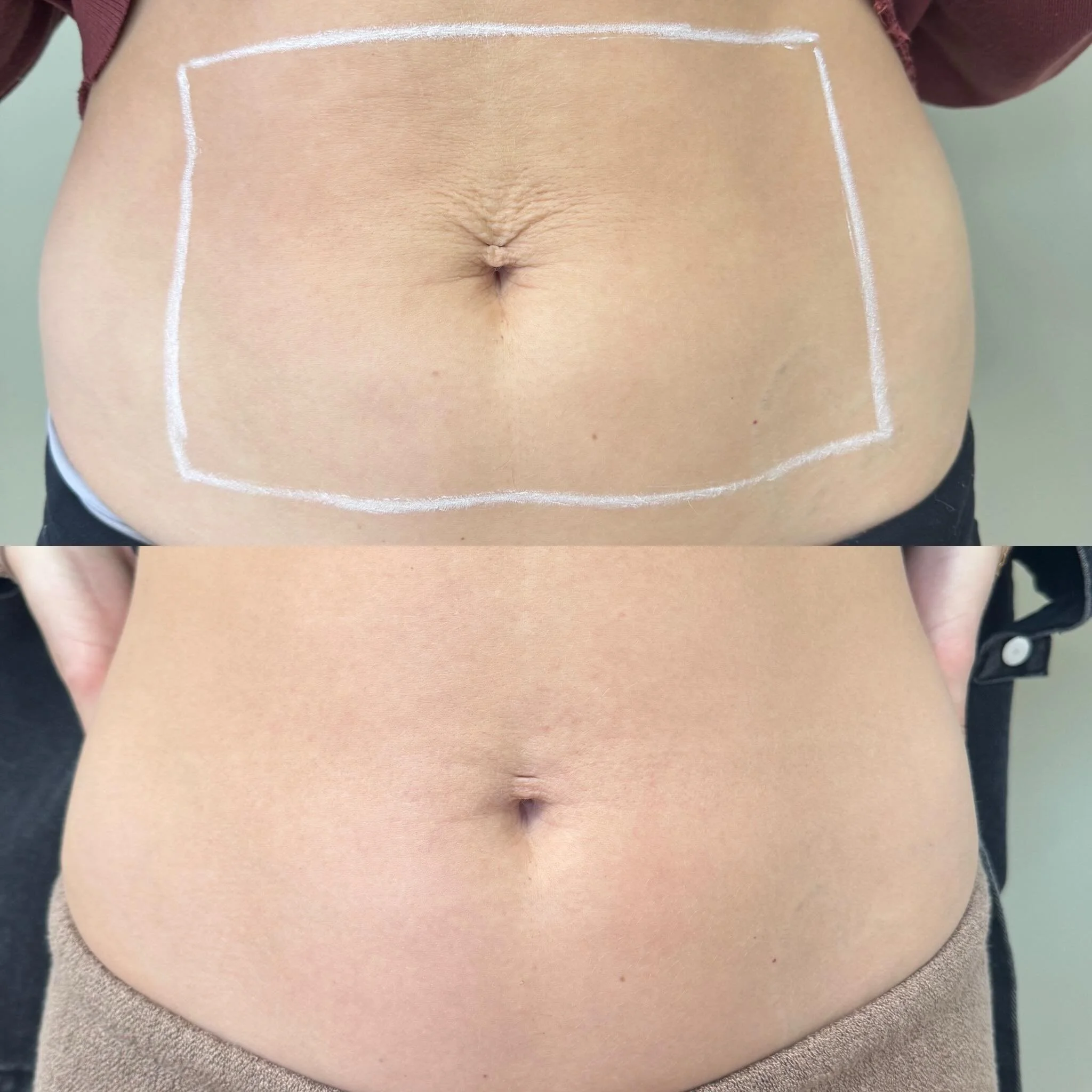 Postpartum skin changes are so common &mdash; and these results are why we love Fotona TightSculpting ✨

After just 2 treatments spaced one month apart, the tightening and smoothing around the abdomen speaks for itself 👏

This treatment works by sti