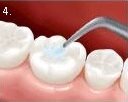 Newport bilgola Avalon mona vale dental childrens dentistry deep pits and fissure seal preventitive resin restorations no 4.jpg