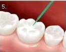 Newport bilgola Avalon mona vale dental childrens dentistry deep pits and fissure seal preventitive resin restorations no 5.jpg