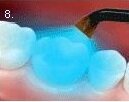 Newport bilgola Avalon mona vale dental childrens dentistry deep pits and fissure seal preventitive resin restorations no 8.jpg