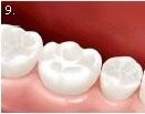 Newport bilgola Avalon mona vale dental childrens dentistry deep pits and fissure seal preventitive resin restorations no 9.jpg