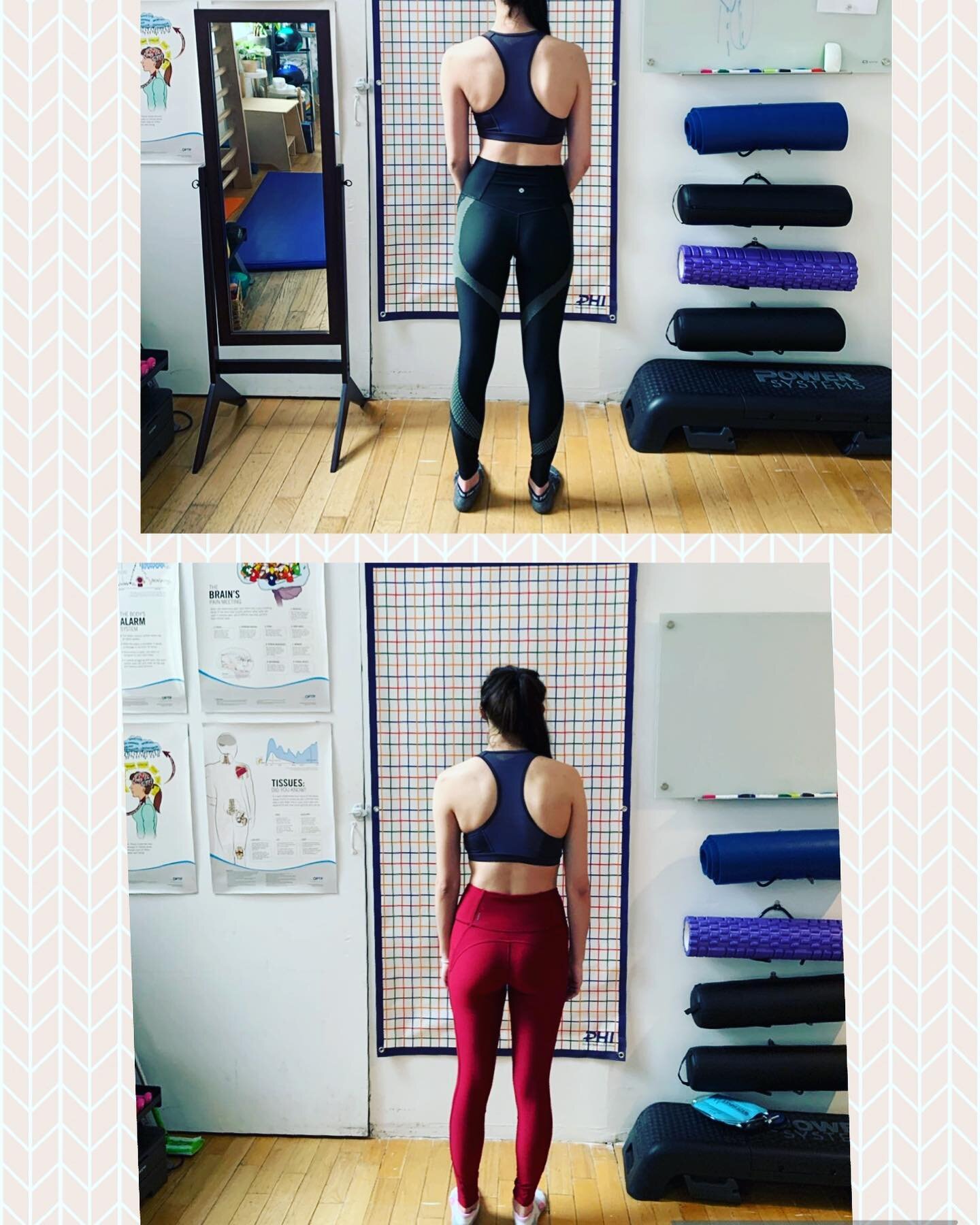 What a great improvement in standing posture in just two weeks of the Schroth program for scoliosis
#schrothmethod #scoliosis #physicaltherapy #rehabilitation #physio #scoliosisexercise #scoliosisstory #physio #posture #lowerbackpain #schroththerapis