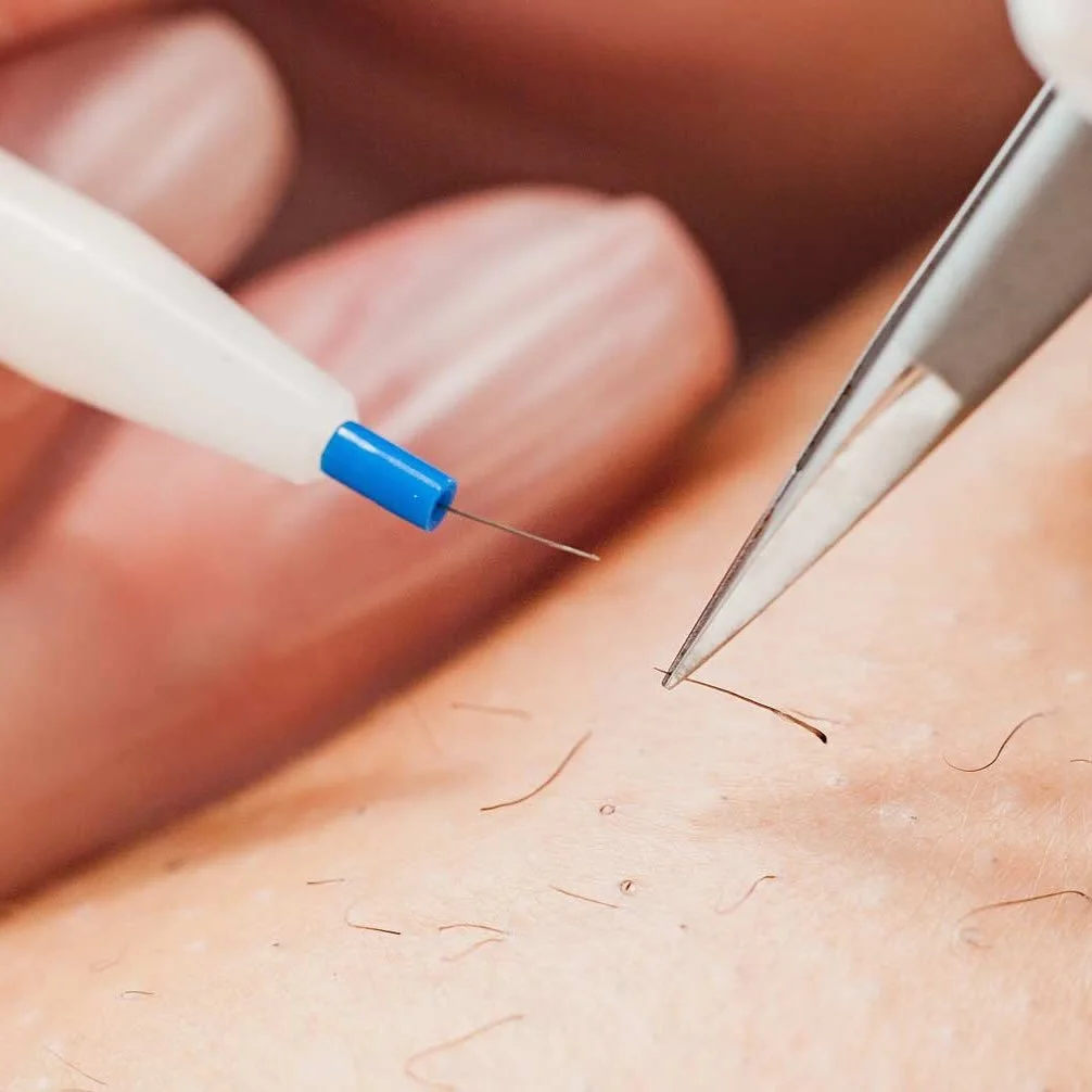 ⚡ Everything You Need to Know About Electrolysis ⚡

You&rsquo;ve probably heard of it&hellip; but what actually is electrolysis hair removal?

Electrolysis is the only FDA-approved method of permanent hair removal &mdash; and unlike laser, it works o