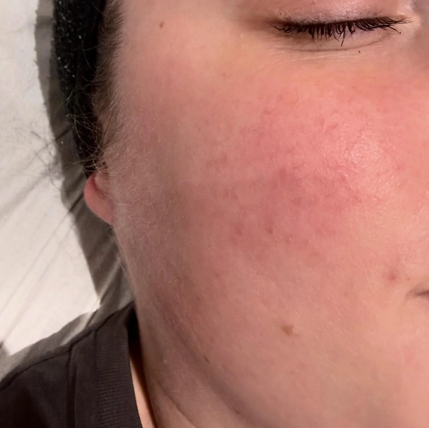 An acid resurfacer to combat redness and sensitivity?!
 
Sounds totally wrong doesn&rsquo;t it? But look at the results!
 
Lactic acid is perfect at the moment, our skin is recovering from festive over indulgence (and possibly stress), bitter wind an