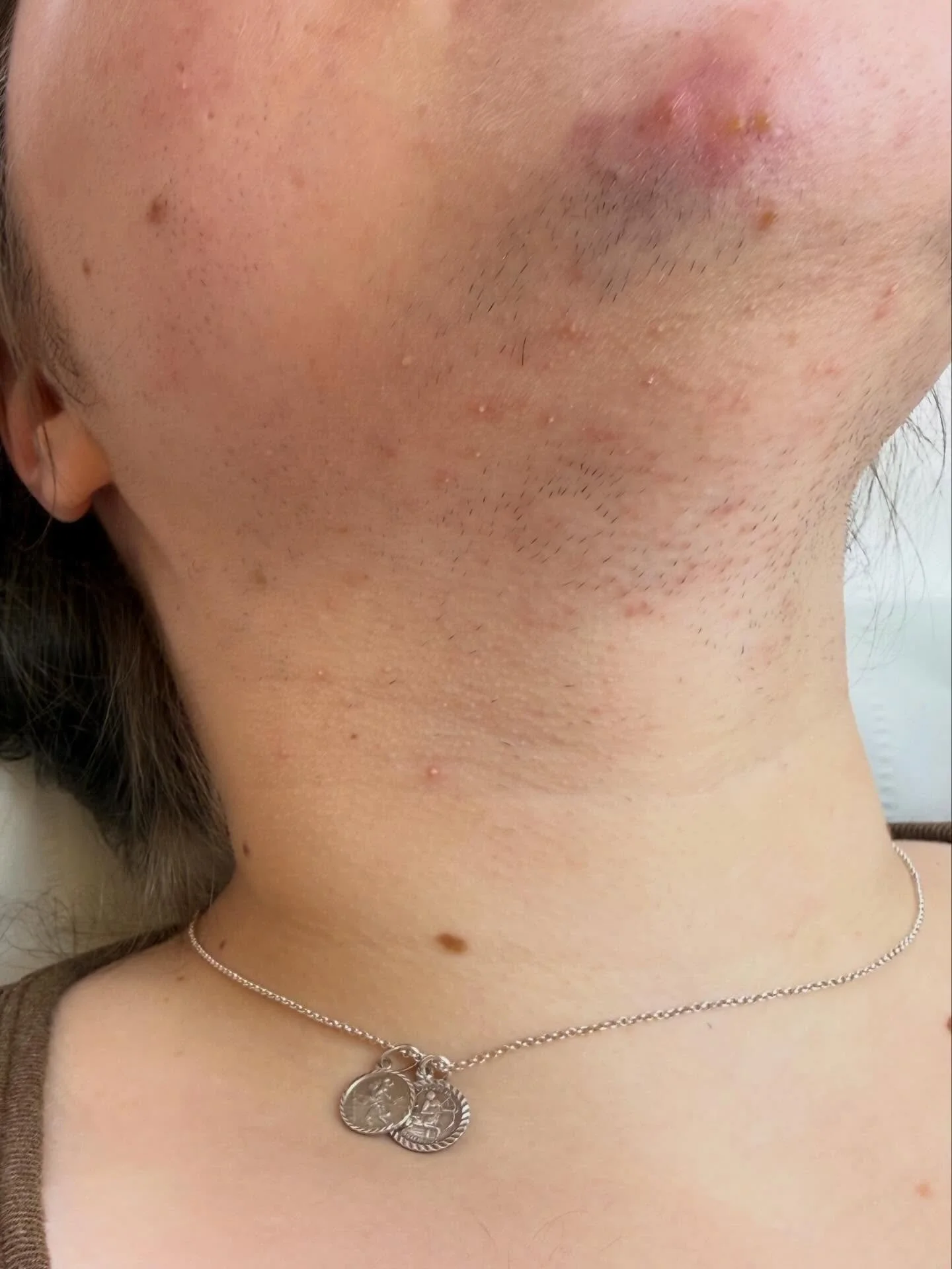 How it started VS how it&rsquo;s going 👀 
 
This lovely young lady first came to me in November with troublesome facial hair, she had tried laser but unfortunately it didn&rsquo;t quite tackle the hair enough. 
 
We decided to tackle her chin first 