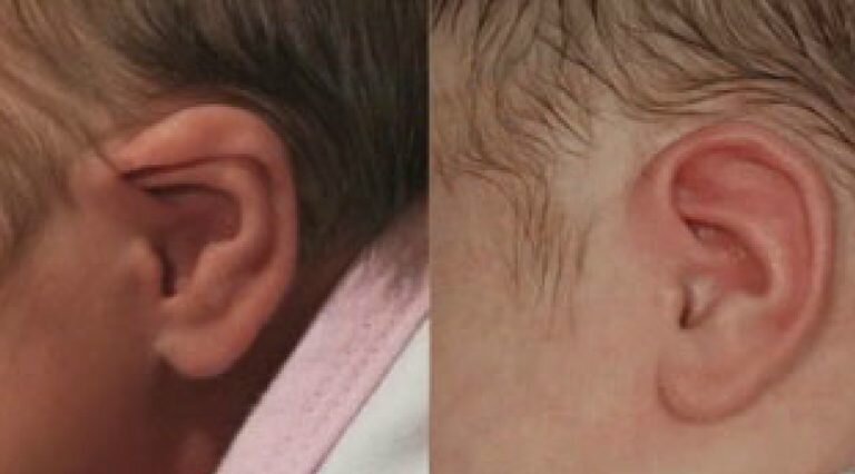 2EarWell®-Infant-Ear-Deformity-Correction-Gallery-2-768x426.jpg