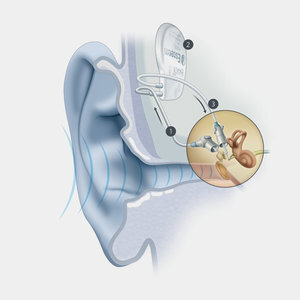 Hearing for the First Time... Sort of