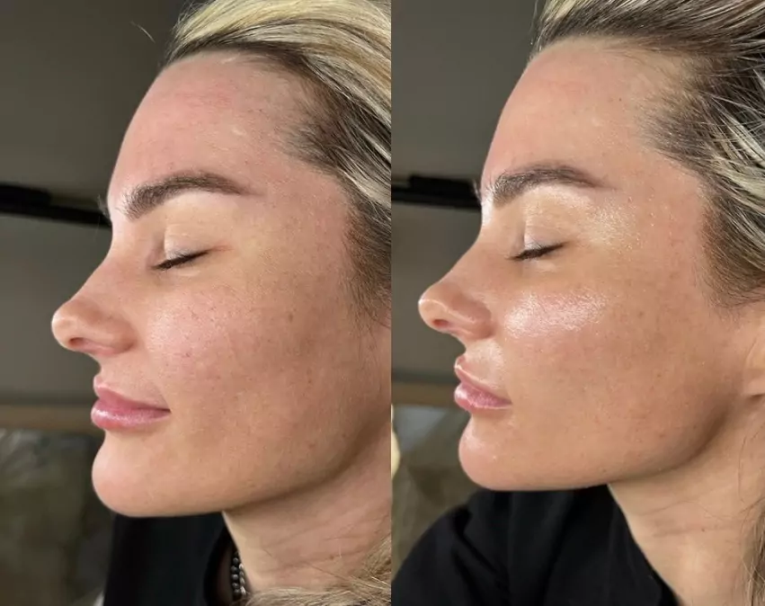 Dermaplaning treatment results in Navarre, Florida
