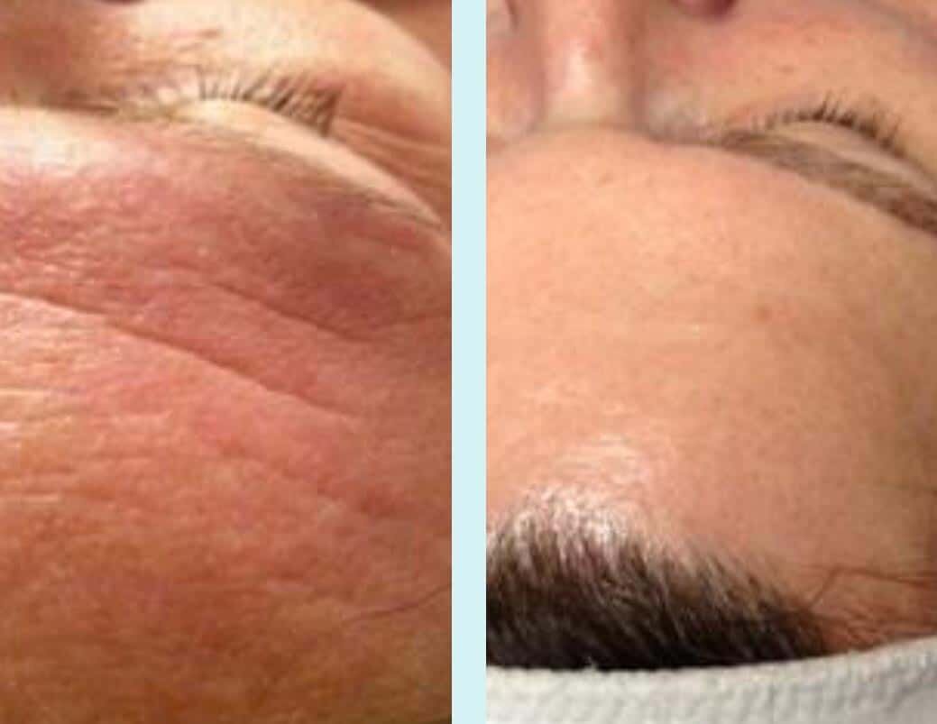 Tri-Wave and Microdermabrasion