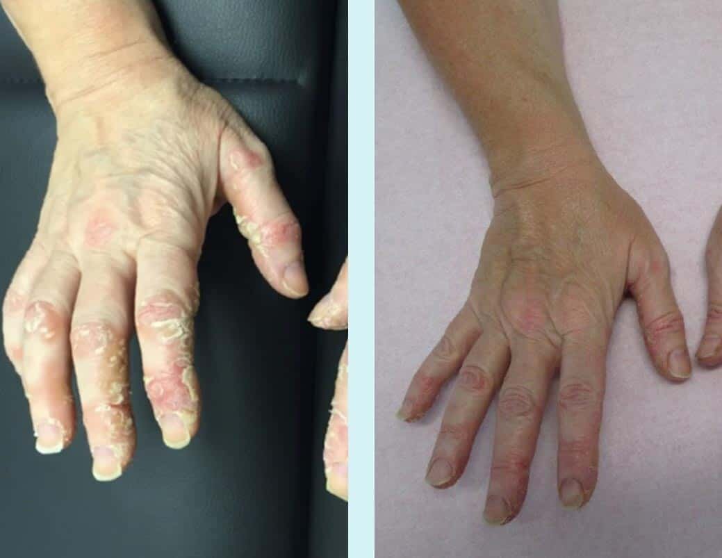 Contact Dermatitis