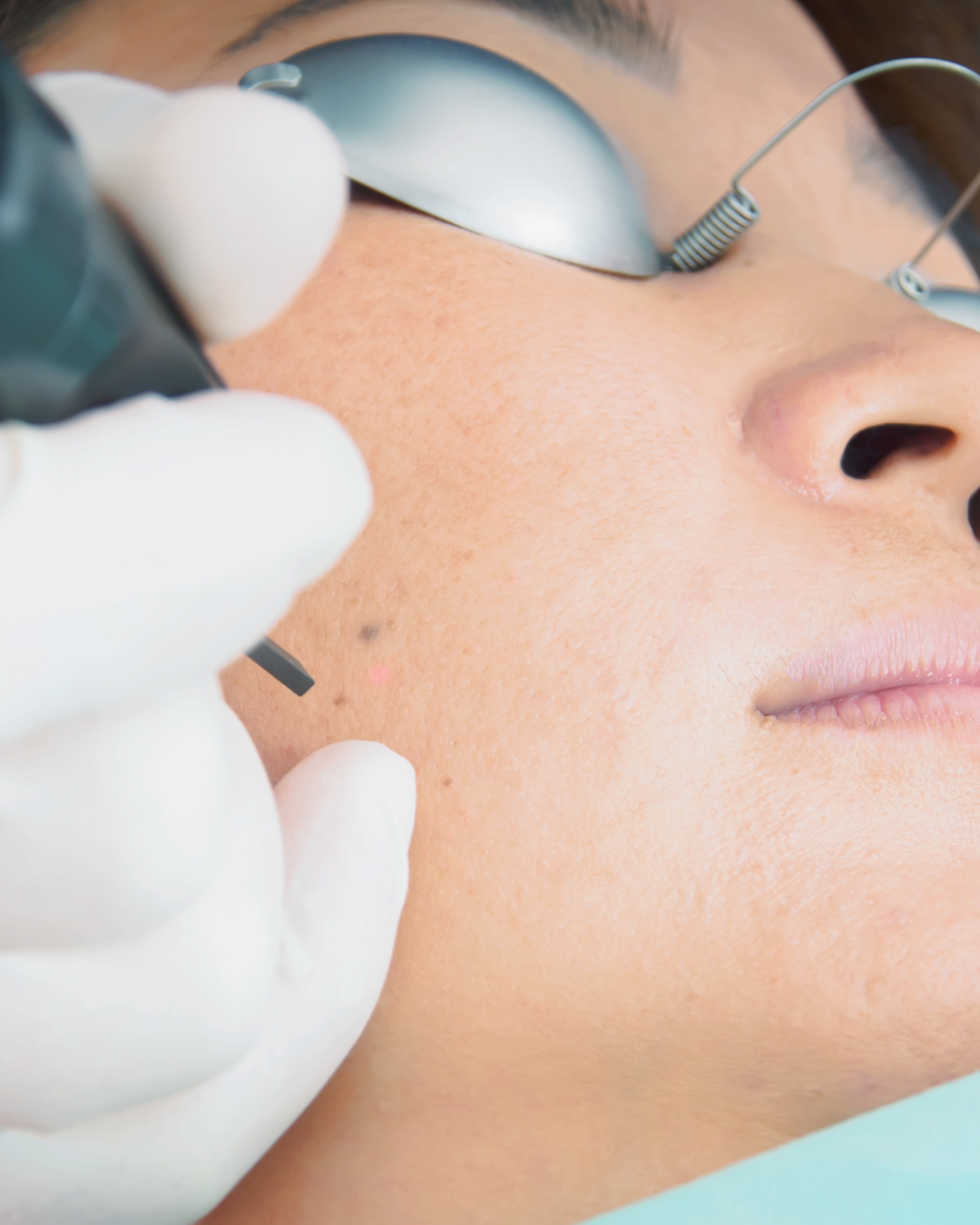 Smooth Skin Starts Here: Laser Hair Removal with Carly at Avance Laser Clinic, Derby